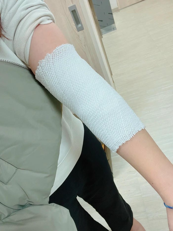 ảnh gãy tay bó bột