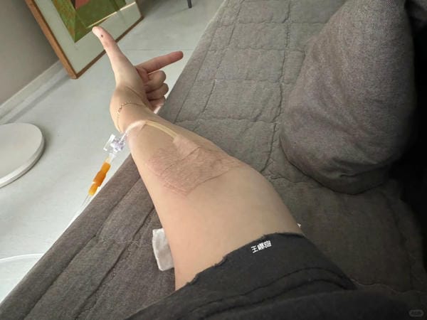 ảnh truyền nước ở tay nam 32