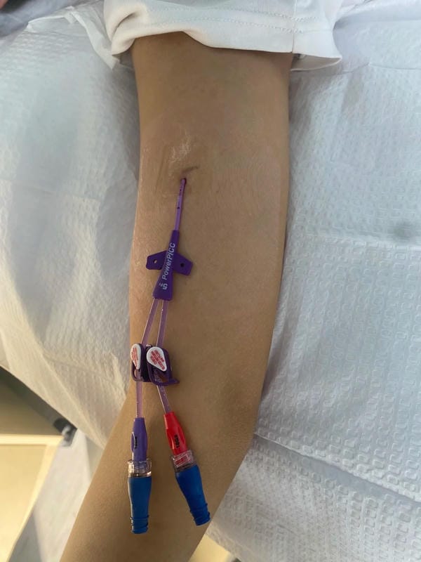 ảnh truyền nước ở tay nam 35