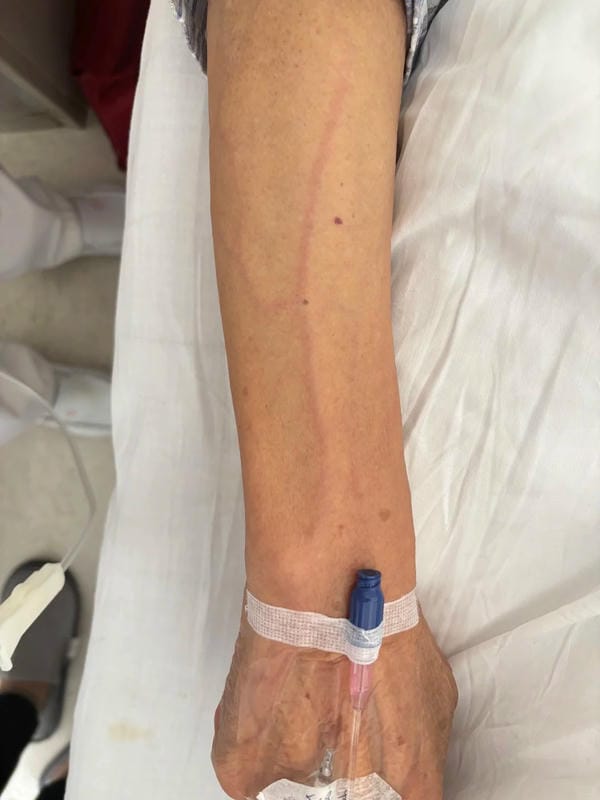 ảnh truyền nước ở tay nam 39