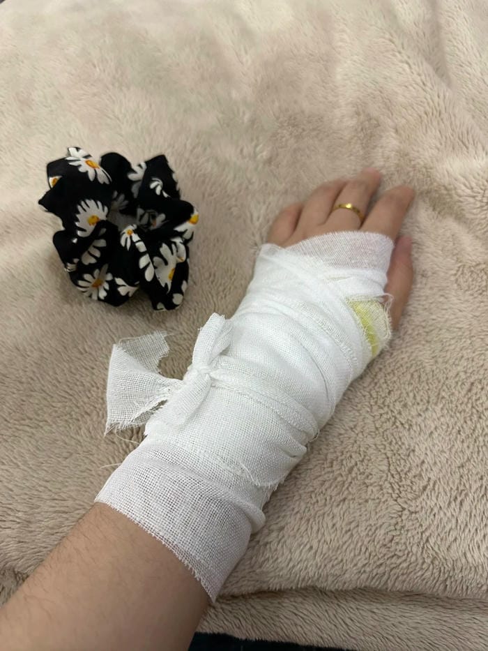 hình ảnh gãy tay bó bột